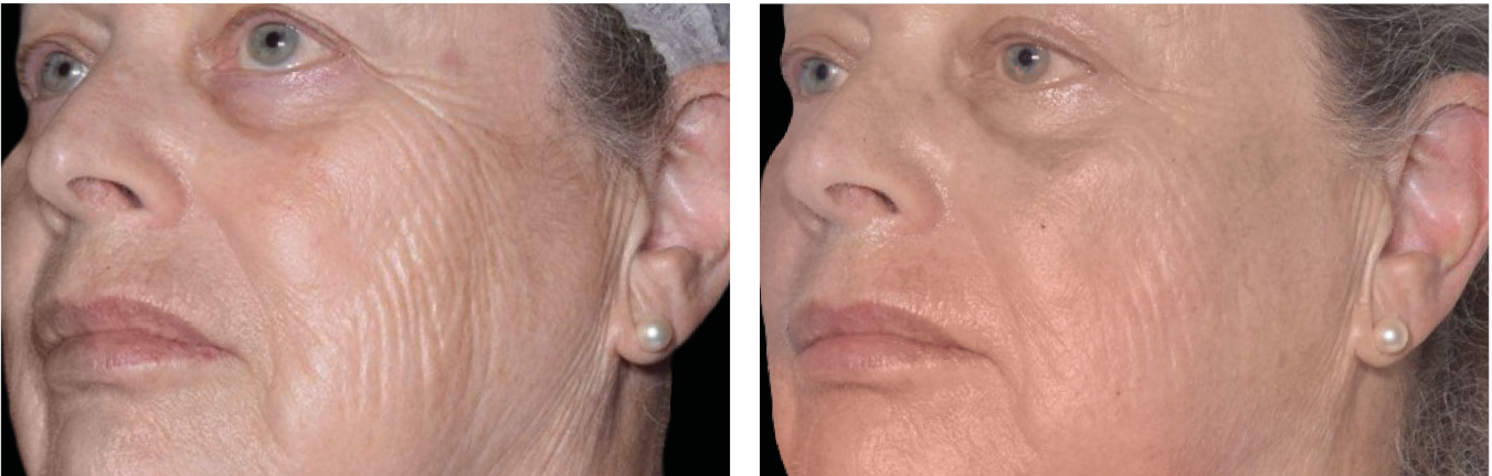 Resultado de tratamento em Rosto